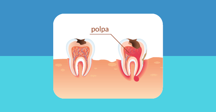 Cosa sono pulpite e come si curano | Studio dentistico Milano Pelizzoni