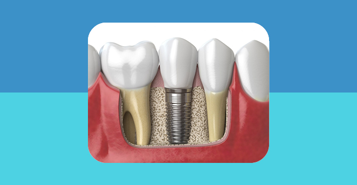 Che cosa sono gli impianti dentali e come mantenerli in salute | studio dentistico Pelizzoni